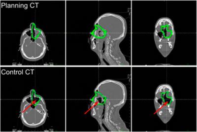 Detection of Interfractional Morphological Changes in Proton Therapy: A Simulation and In Vivo Study With the INSIDE In-Beam PET
